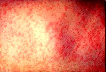 Measles Rash